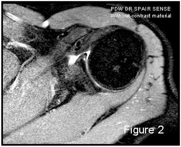 MRI using joint effusion as contrast in the acute setting