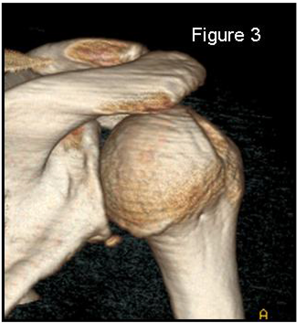 3D CT of a humeral head bone defect