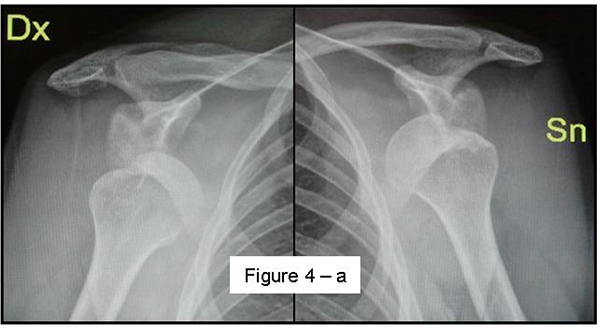 Bilateral Hill-Sachs lesions on an anteroposterior radiograph