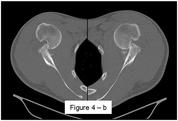 Axial CT of bilateral engaging Hill-Sachs lesions