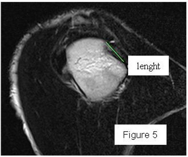 Hill-Sachs lesion length on sagittal CT