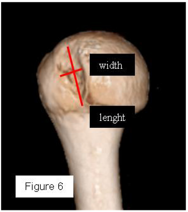 3D CT en face view of the humerus with the scapula removed