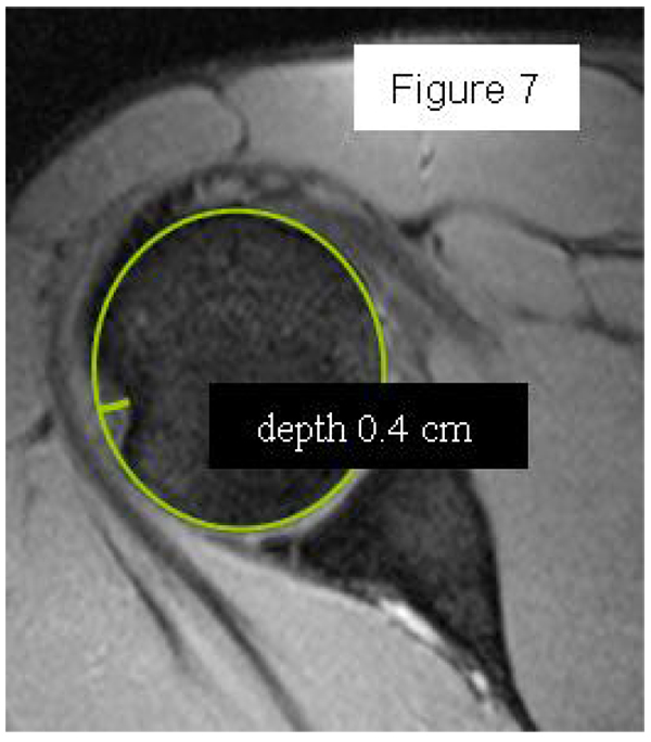 Humeral defect depth on axial CT, circle method
